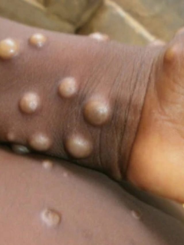 Monkey pox emergency in US: Illinois daycare worker tests positive